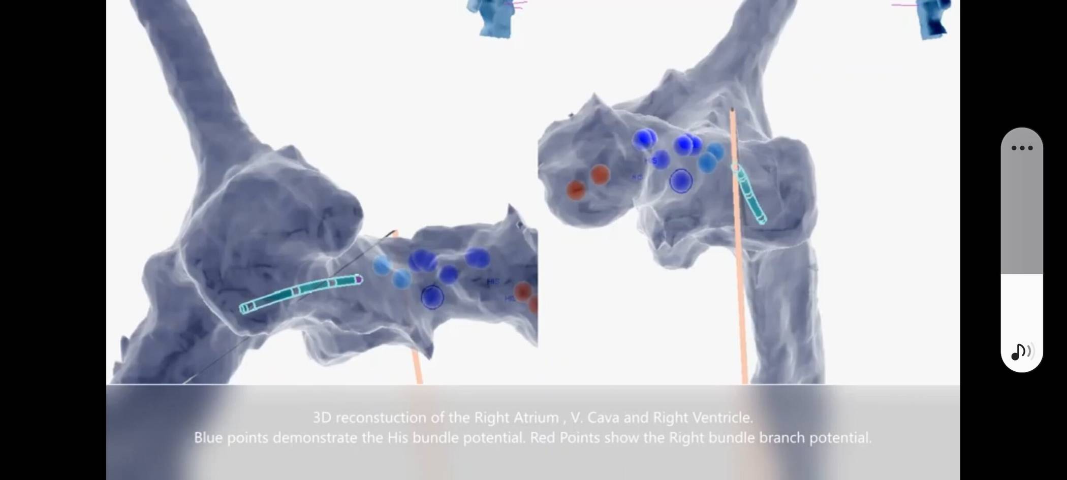  Modernste Verfahren im Elisabeth-Krankenhaus: Das His-Bu&amp;#x308;ndel ist ein Teil  des herzeigenen Erregungsleitungssystems. Die His-Bu&amp;#x308;ndel-Stimulation wird  im Eli seit mehreren Jahren angewendet. 