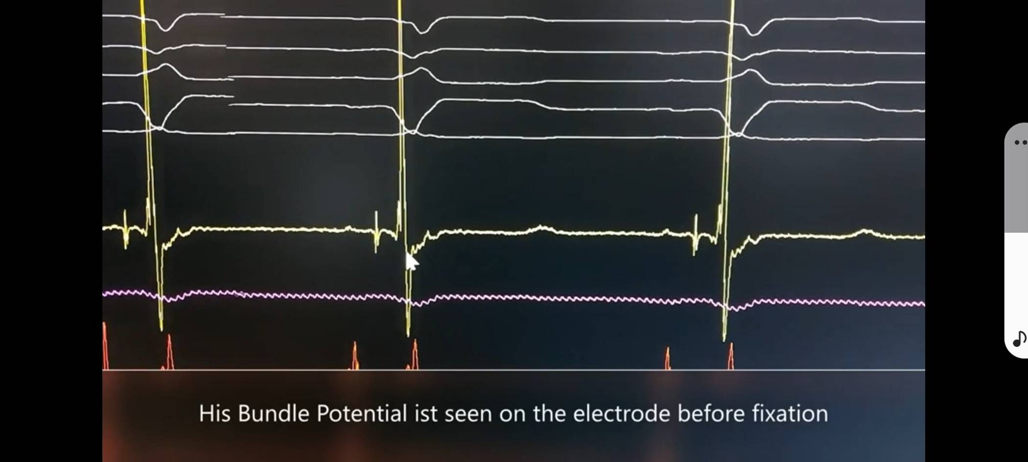 Eli-Natürliche Stimulation mit moderner Herzschrittmachertechnik