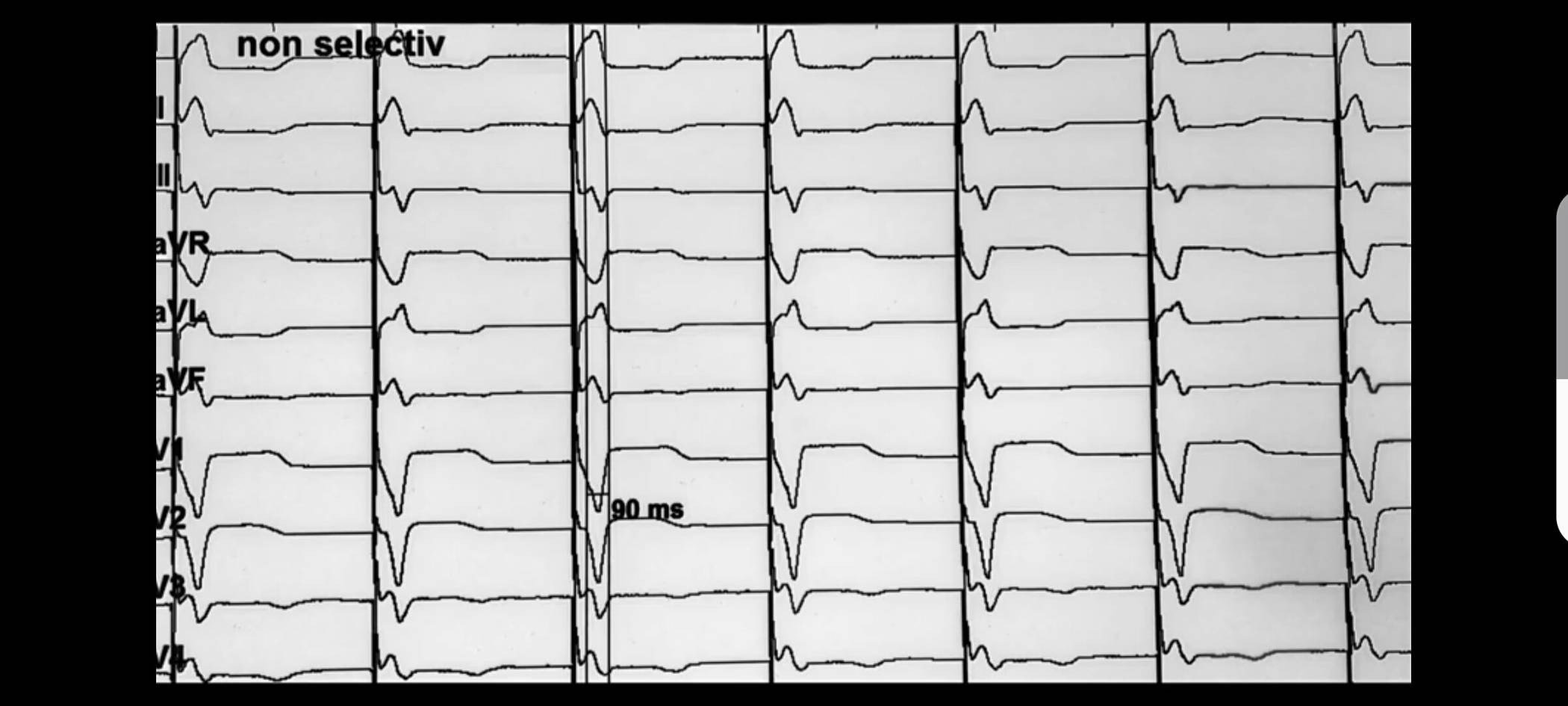 Eli-Natürliche Stimulation mit moderner Herzschrittmachertechnik
