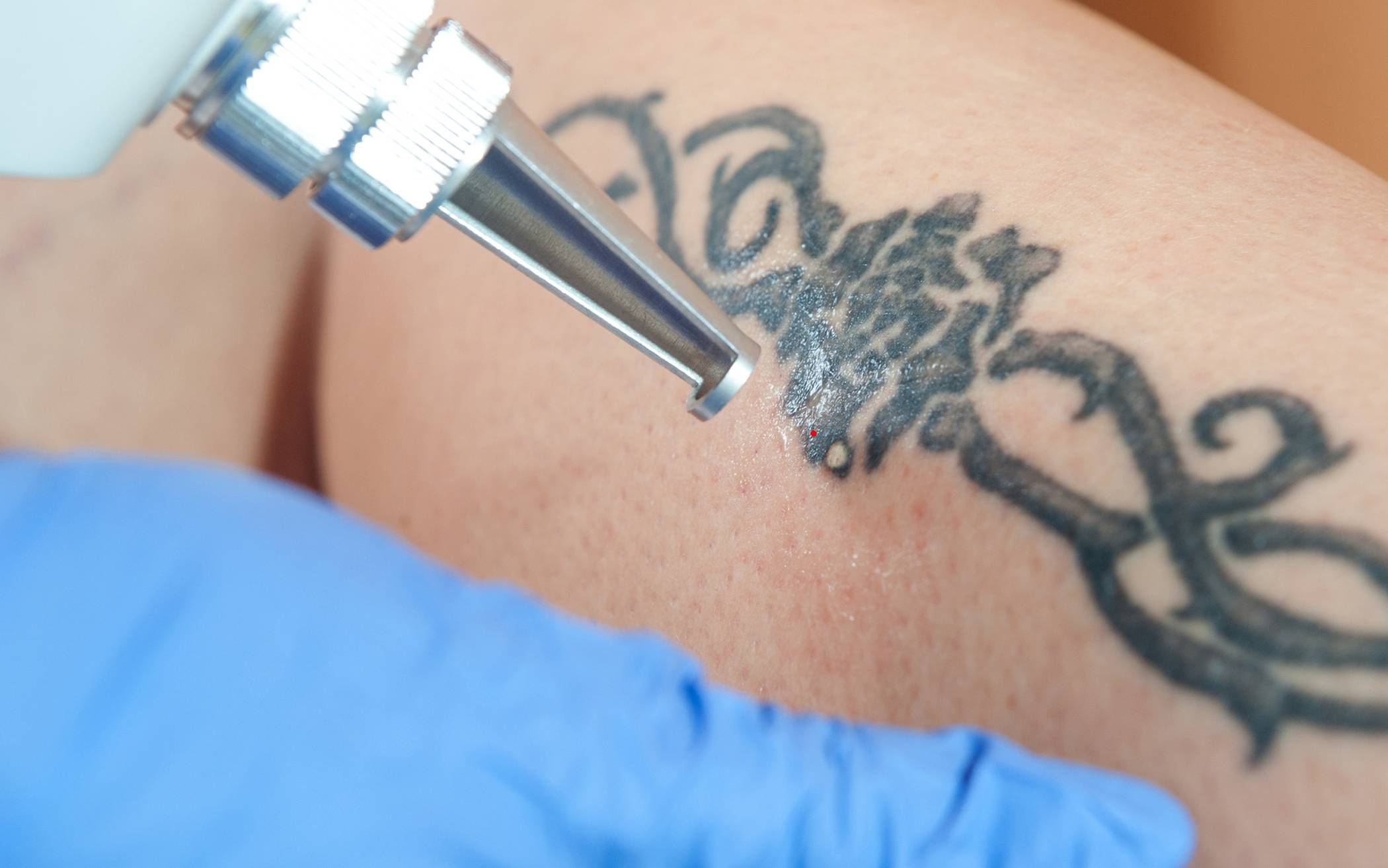 Bilder auf der Haut: ein Leben lang? Bei der Tattoo-Entfernung gibt es verschiedene Methoden, die aber auch Risiken beinhalten. 