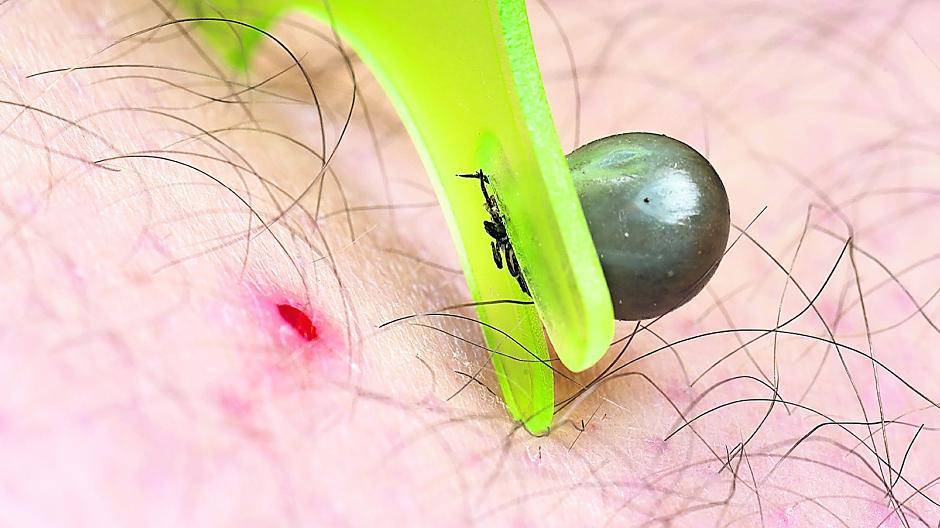  Vollgesogen: Die Zecke und ihr Feind, die Zeckenzange. Foto: mirkograul/ fotolia.de 