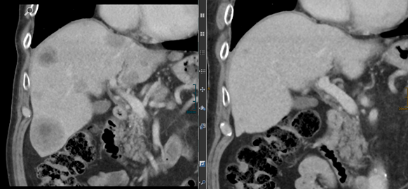  Die Röntgenaufnahme von Bernd Kirchhausens Leber: Links mit Metastasen (schwarze Punkte) aus 2015, rechts die aktuelle befundfreie Aufnahme. 