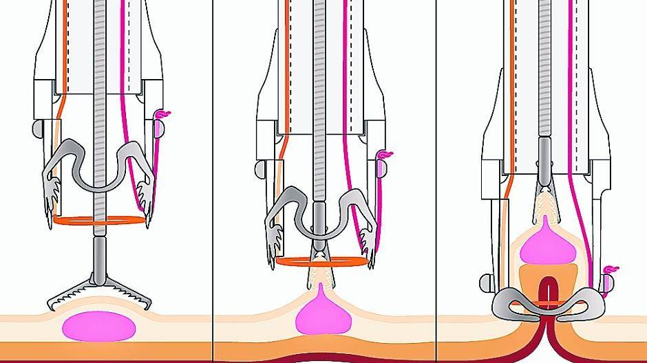 Per Endoskop wird die zuvor markierte Stelle der Darmwand gegriffen und entfernt.