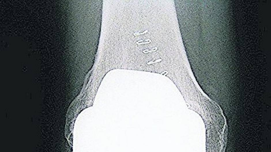  Anhand einer CT-Aufnahme werden im Eli nun Schablonen aus einem 3-D-Drucker direkt in den USA gefertigt.  