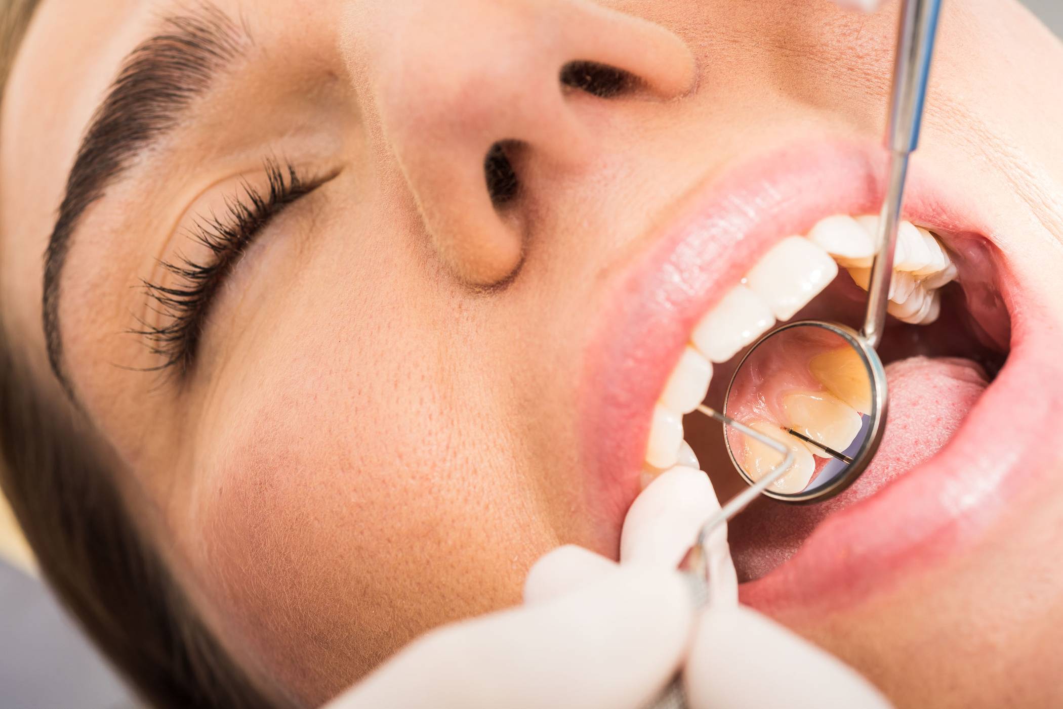 Mit einem PSI -Test misst der Zahnarzt die Tiefe der Taschen. Das ist der Bereich zwischen Zähnen und Zahnfleisch. Das Zahnfleisch entzündet sich schleichend und bleibt auch in diesem Zustand lange schmerzfrei.