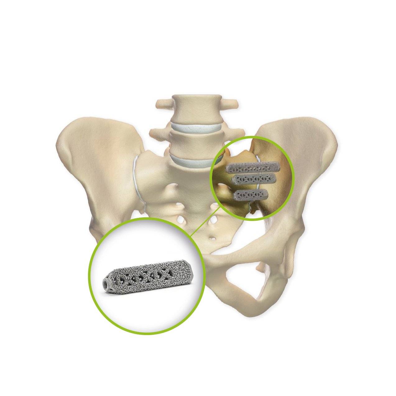 Moderne iFuse-Implantate (Kassenleistung) von SI-BONE stabilisieren das Iliosakralgelenk.